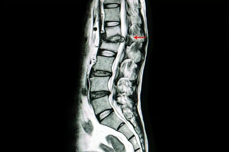Referensi Dokter Saraf & Spine untuk Nyeri Tulang Belakang