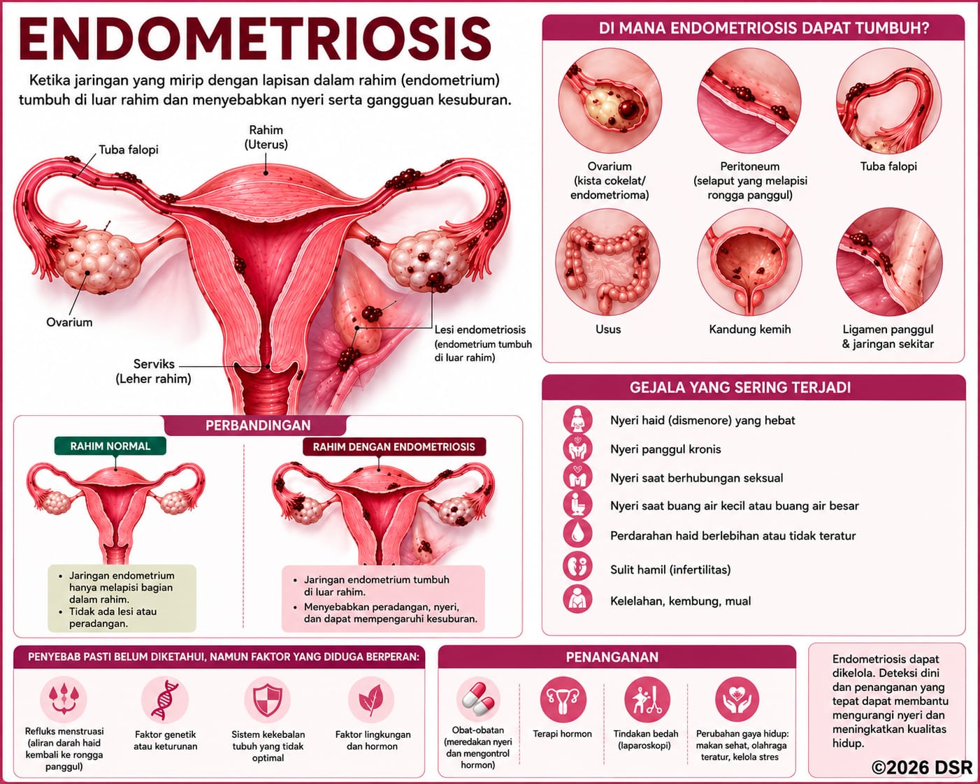 Endometriosis