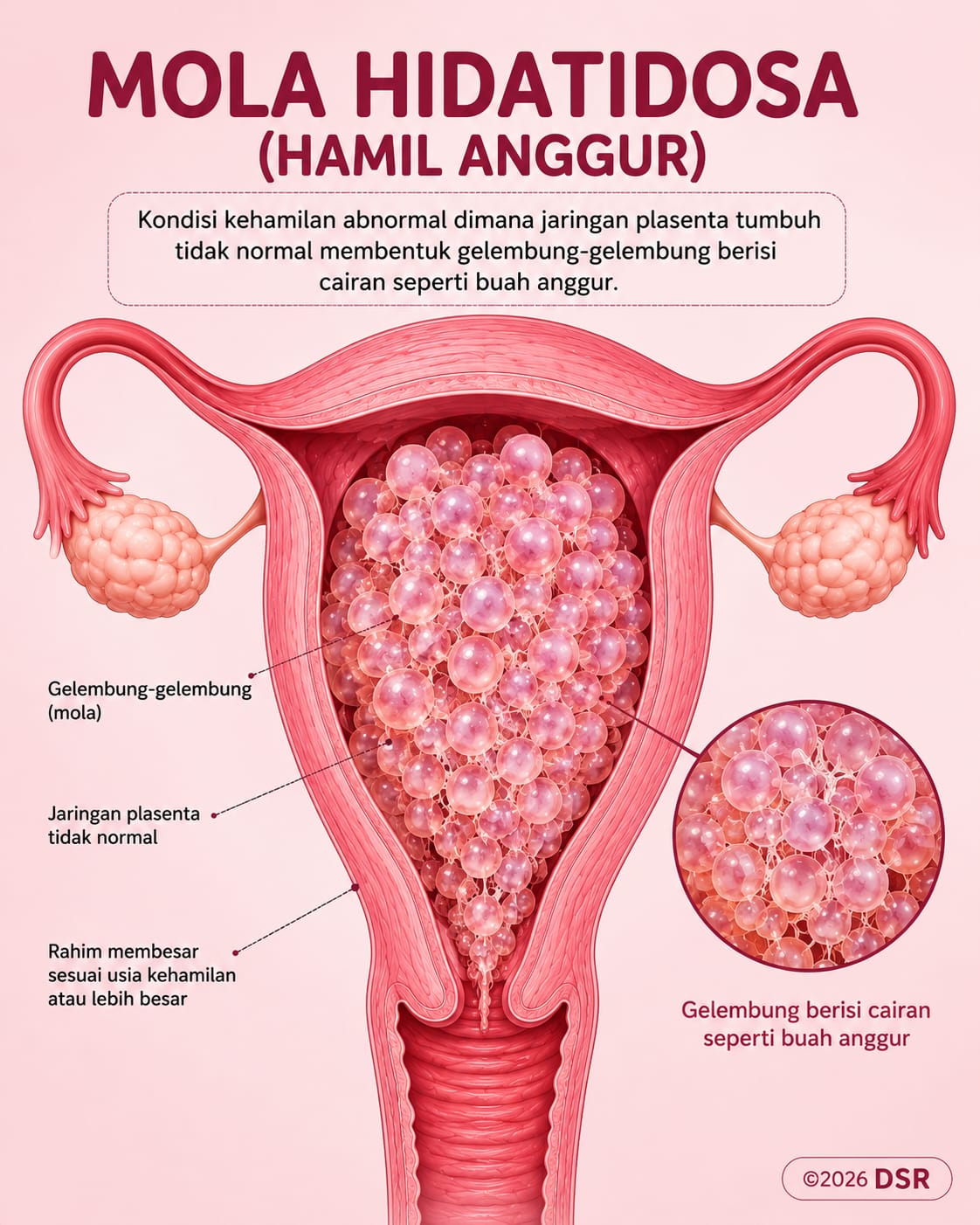 Mola Hidatidosa (Hamil Anggur): Penyebab, Gejala, Diagnosis, Pengobatan, dan Pencegahannya